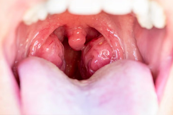 Tonsils